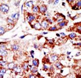PIAS2 / PIASX Antibody - Formalin-fixed and paraffin-embedded human cancer tissue reacted with the primary antibody, which was peroxidase-conjugated to the secondary antibody, followed by DAB staining. This data demonstrates the use of this antibody for immunohistochemistry; clinical relevance has not been evaluated. BC = breast carcinoma; HC = hepatocarcinoma.