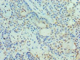 PIAS3 Antibody - Immunohistochemistry of paraffin-embedded human breast cancer using antibody at 1:100 dilution.