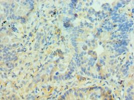 PIAS3 Antibody - Immunohistochemistry of paraffin-embedded human lung cancer using antibody at 1:100 dilution.