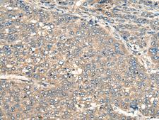PIAS3 Antibody - Immunohistochemistry of paraffin-embedded Human liver cancer tissue  using PIAS3 Polyclonal Antibody at dilution of 1:55(×200)