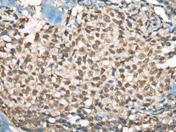 PIAS3 Antibody - Immunohistochemistry of paraffin-embedded Human ovarian cancer tissue  using PIAS3 Polyclonal Antibody at dilution of 1:55(×200)