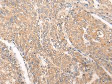 PIAS3 Antibody - Immunohistochemistry of paraffin-embedded Human liver cancer tissue  using PIAS3 Polyclonal Antibody at dilution of 1:40(×200)