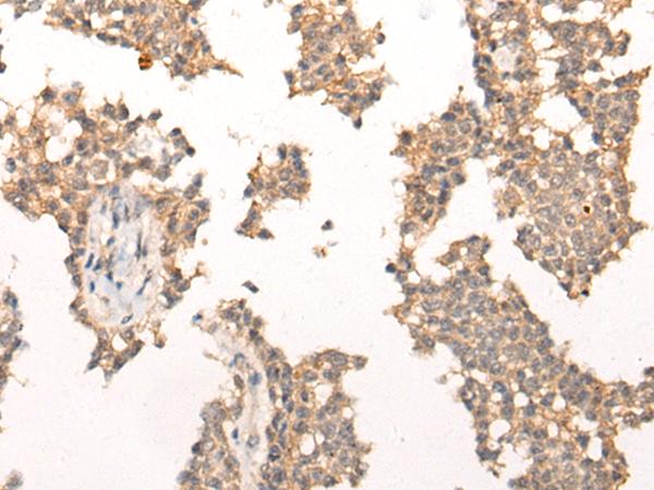 PIAS3 Antibody - Immunohistochemistry of paraffin-embedded Human ovarian cancer tissue  using PIAS3 Polyclonal Antibody at dilution of 1:40(×200)