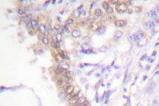 PIAS3 Antibody - IHC of PIAS3 (F25) pAb in paraffin-embedded human lung carcinoma tissue.
