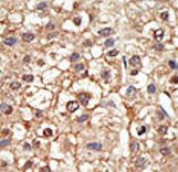 PIAS4 / PIASY Antibody - Formalin-fixed and paraffin-embedded human cancer tissue reacted with the primary antibody, which was peroxidase-conjugated to the secondary antibody, followed by DAB staining. This data demonstrates the use of this antibody for immunohistochemistry; clinical relevance has not been evaluated. BC = breast carcinoma; HC = hepatocarcinoma.