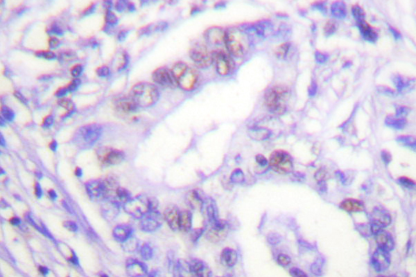 PIAS4 / PIASY Antibody - IHC of PIAS4 (D488) pAb in paraffin-embedded human lung carcinoma tissue.