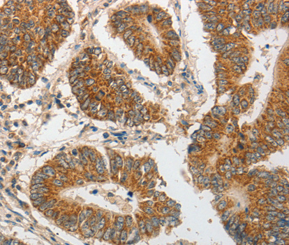 PIBF1 / PIBF Antibody - Immunohistochemistry of paraffin-embedded human colon tissue.