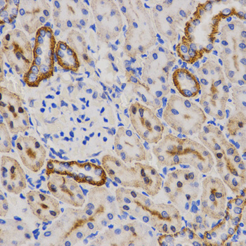PIBF1 / PIBF Antibody - Immunohistochemistry of paraffin-embedded human rectal cancer tissue.