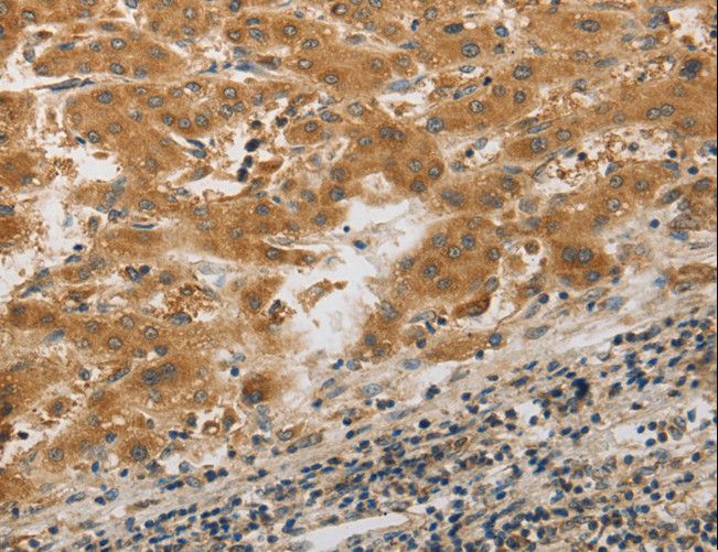 PIBF1 / PIBF Antibody - Immunohistochemistry of paraffin-embedded Human liver cancer using PIBF1 Polyclonal Antibody at dilution of 1:20.