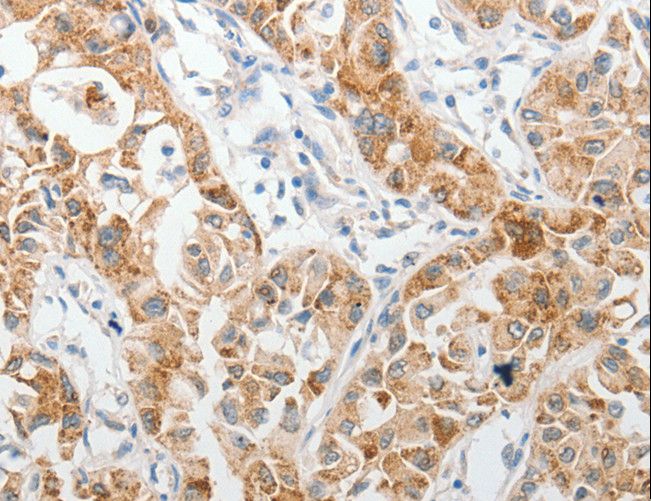 PIBF1 / PIBF Antibody - Immunohistochemistry of paraffin-embedded Human lung cancer using PIBF1 Polyclonal Antibody at dilution of 1:60.