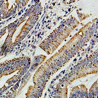 PIBF1 / PIBF Antibody - Immunohistochemical analysis of PIBF staining in human colon cancer formalin fixed paraffin embedded tissue section. The section was pre-treated using heat mediated antigen retrieval with sodium citrate buffer (pH 6.0). The section was then incubated with the antibody at room temperature and detected using an HRP conjugated compact polymer system. DAB was used as the chromogen. The section was then counterstained with hematoxylin and mounted with DPX.