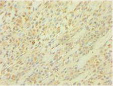 PICK1 Antibody - Immunohistochemistry of paraffin-embedded human breast cancer using PICK1 Antibody at dilution of 1:100