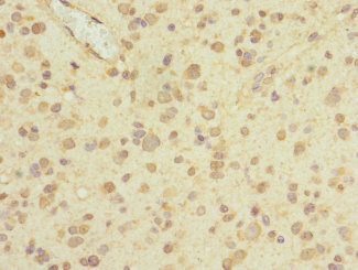 PIEZO1 / FAM38A Antibody - Immunohistochemistry of paraffin-embedded human glioma at dilution 1:100