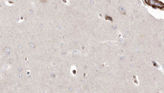 PIEZO1 / FAM38A Antibody - 1:100 staining human brain carcinoma tissue by IHC-P. The sample was formaldehyde fixed and a heat mediated antigen retrieval step in citrate buffer was performed. The sample was then blocked and incubated with the antibody for 1.5 hours at 22°C. An HRP conjugated goat anti-rabbit antibody was used as the secondary.