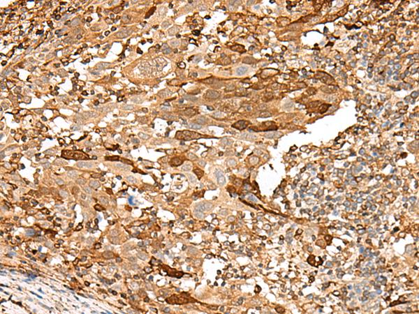 PIEZO2 / FAM38B Antibody - Immunohistochemistry of paraffin-embedded Human cervical cancer tissue  using PIEZO2 Polyclonal Antibody at dilution of 1:55(×200)