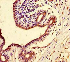 PIF1 Antibody - Immunohistochemistry of paraffin-embedded human breast cancer at dilution of 1:100