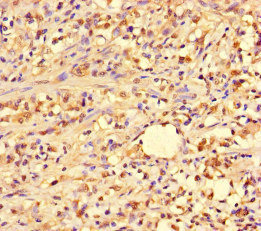 PIF1 Antibody - Immunohistochemistry of paraffin-embedded human gastric cancer at dilution of 1:100