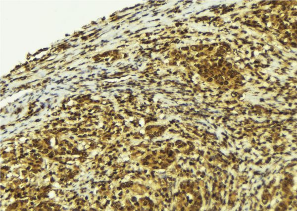 PIF1 Antibody - 1:100 staining human breast carcinoma tissue by IHC-P. The sample was formaldehyde fixed and a heat mediated antigen retrieval step in citrate buffer was performed. The sample was then blocked and incubated with the antibody for 1.5 hours at 22°C. An HRP conjugated goat anti-rabbit antibody was used as the secondary.