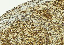 PIF1 Antibody - 1:100 staining human breast carcinoma tissue by IHC-P. The sample was formaldehyde fixed and a heat mediated antigen retrieval step in citrate buffer was performed. The sample was then blocked and incubated with the antibody for 1.5 hours at 22°C. An HRP conjugated goat anti-rabbit antibody was used as the secondary.