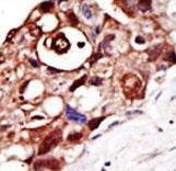 PIGK Antibody - Formalin-fixed and paraffin-embedded human cancer tissue reacted with the primary antibody, which was peroxidase-conjugated to the secondary antibody, followed by DAB staining. This data demonstrates the use of this antibody for immunohistochemistry; clinical relevance has not been evaluated. BC = breast carcinoma; HC = hepatocarcinoma.