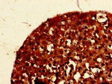 PIGK Antibody - Immunohistochemistry of paraffin-embedded human breast cancer at dilution of 1:100