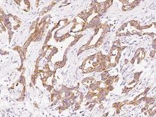 PIGK Antibody - Immunochemical staining of human PIGK in human breast carcinoma with rabbit polyclonal antibody at 1:200 dilution, formalin-fixed paraffin embedded sections.