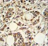 PIGM Antibody - PIGM Antibody IHC of formalin-fixed and paraffin-embedded breast carcinoma followed by peroxidase-conjugated secondary antibody and DAB staining.