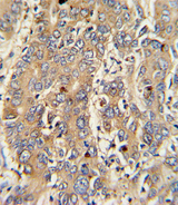 PIGR Antibody - Formalin-fixed and paraffin-embedded human hepatocarcinoma with PIGR Antibody , which was peroxidase-conjugated to the secondary antibody, followed by DAB staining. This data demonstrates the use of this antibody for immunohistochemistry; clinical relevance has not been evaluated.