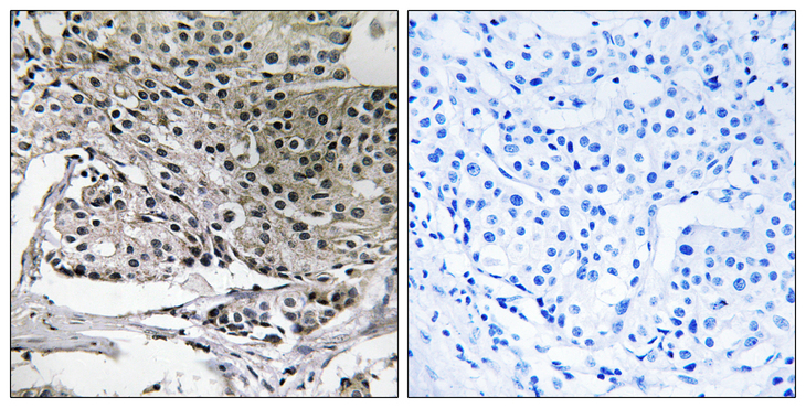 PIGY Antibody - Immunohistochemistry analysis of paraffin-embedded human breast carcinoma tissue, using PIGY Antibody. The picture on the right is blocked with the synthesized peptide.