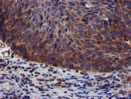 PIH1D2 Antibody - IHC of paraffin-embedded Carcinoma of Human bladder tissue using anti-PIH1D2 mouse monoclonal antibody.