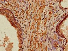 PIH1D3 Antibody - Immunohistochemistry of paraffin-embedded human prostate cancer using PIH1D3 Antibody at dilution of 1:100