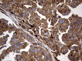 PIK3C2A Antibody - IHC of paraffin-embedded Carcinoma of Human bladder tissue using anti-PIK3C2A mouse monoclonal antibody. (Heat-induced epitope retrieval by 10mM citric buffer, pH6.0, 120°C for 3min).