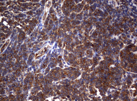 PIK3C2A Antibody - IHC of paraffin-embedded Human lymphoma tissue using anti-PIK3C2A mouse monoclonal antibody. (Heat-induced epitope retrieval by 10mM citric buffer, pH6.0, 120°C for 3min).