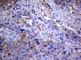 PIK3C2A Antibody - IHC of paraffin-embedded Adenocarcinoma of Human ovary tissue using anti-PIK3C2A mouse monoclonal antibody. (Heat-induced epitope retrieval by 10mM citric buffer, pH6.0, 120°C for 3min).