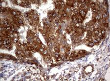 PIK3C2A Antibody - IHC of paraffin-embedded Carcinoma of Human liver tissue using anti-PIK3C2A mouse monoclonal antibody. (Heat-induced epitope retrieval by 10mM citric buffer, pH6.0, 120°C for 3min).
