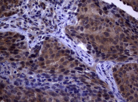 PIK3C2A Antibody - IHC of paraffin-embedded Carcinoma of Human lung tissue using anti-PIK3C2A mouse monoclonal antibody. (Heat-induced epitope retrieval by 10mM citric buffer, pH6.0, 120°C for 3min).