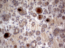 PIK3C2A Antibody - IHC of paraffin-embedded Carcinoma of Human thyroid tissue using anti-PIK3C2A mouse monoclonal antibody. (Heat-induced epitope retrieval by 10mM citric buffer, pH6.0, 120°C for 3min).