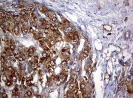PIK3C2A Antibody - IHC of paraffin-embedded Carcinoma of Human liver tissue using anti-PIK3C2A mouse monoclonal antibody. (Heat-induced epitope retrieval by 10mM citric buffer, pH6.0, 120°C for 3min).
