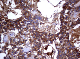 PIK3C2A Antibody - IHC of paraffin-embedded Carcinoma of Human pancreas tissue using anti-PIK3C2A mouse monoclonal antibody. (Heat-induced epitope retrieval by 10mM citric buffer, pH6.0, 120°C for 3min).