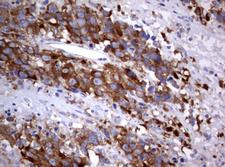 PIK3C2A Antibody - IHC of paraffin-embedded Adenocarcinoma of Human ovary tissue using anti-PIK3C2A mouse monoclonal antibody. (Heat-induced epitope retrieval by 10mM citric buffer, pH6.0, 120°C for 3min).