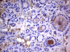 PIK3C2A Antibody - IHC of paraffin-embedded Carcinoma of Human thyroid tissue using anti-PIK3C2A mouse monoclonal antibody. (Heat-induced epitope retrieval by 10mM citric buffer, pH6.0, 120°C for 3min).