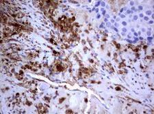 PIK3C2A Antibody - IHC of paraffin-embedded Adenocarcinoma of Human breast tissue using anti-PIK3C2A mouse monoclonal antibody. (Heat-induced epitope retrieval by 10mM citric buffer, pH6.0, 120°C for 3min).
