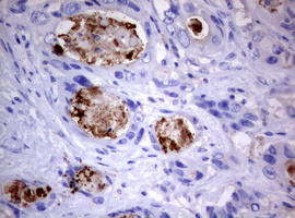 PIK3C2A Antibody - IHC of paraffin-embedded Adenocarcinoma of Human colon tissue using anti-PIK3C2A mouse monoclonal antibody. (Heat-induced epitope retrieval by 10mM citric buffer, pH6.0, 120°C for 3min).