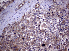 PIK3C2A Antibody - IHC of paraffin-embedded Adenocarcinoma of Human endometrium tissue using anti-PIK3C2A mouse monoclonal antibody. (Heat-induced epitope retrieval by 10mM citric buffer, pH6.0, 120°C for 3min).