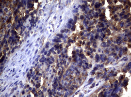 PIK3C2A Antibody - IHC of paraffin-embedded Adenocarcinoma of Human endometrium tissue using anti-PIK3C2A mouse monoclonal antibody. (Heat-induced epitope retrieval by 10mM citric buffer, pH6.0, 120°C for 3min).
