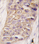 PIK3C2B Antibody - Formalin-fixed and paraffin-embedded human breast carcinoma tissue reacted with PI3KC2B antibody , which was peroxidase-conjugated to the secondary antibody, followed by DAB staining. This data demonstrates the use of this antibody for immunohistochemistry; clinical relevance has not been evaluated.