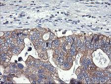 PIK3C2B Antibody - IHC of paraffin-embedded Adenocarcinoma of Human breast tissue using anti-PIK3C2B mouse monoclonal antibody.