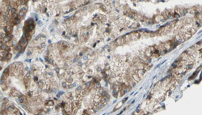 PIK3C2G Antibody - 1:100 staining human prostate tissue by IHC-P. The sample was formaldehyde fixed and a heat mediated antigen retrieval step in citrate buffer was performed. The sample was then blocked and incubated with the antibody for 1.5 hours at 22°C. An HRP conjugated goat anti-rabbit antibody was used as the secondary.