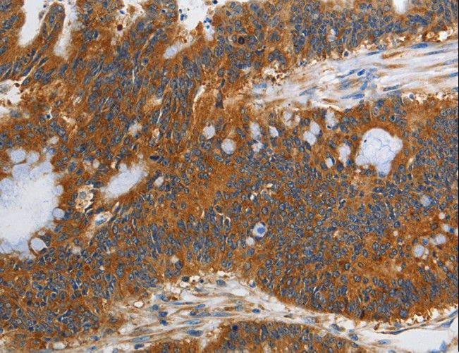 PIK3C3 / VPS34 Antibody - Immunohistochemistry of paraffin-embedded Human gastric cancer using PIK3C3 Polyclonal Antibody at dilution of 1:40.