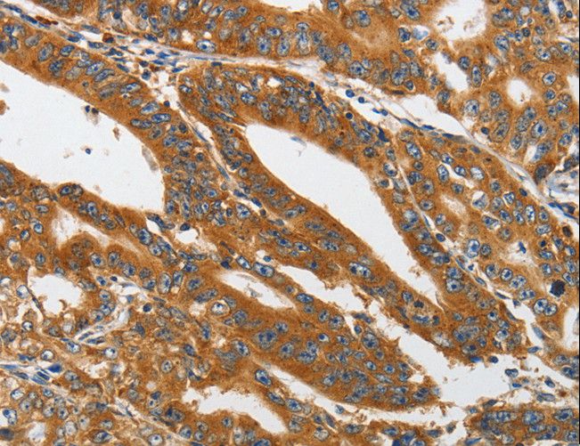 PIK3C3 / VPS34 Antibody - Immunohistochemistry of paraffin-embedded Human gastric cancer using PIK3C3 Polyclonal Antibody at dilution of 1:40.